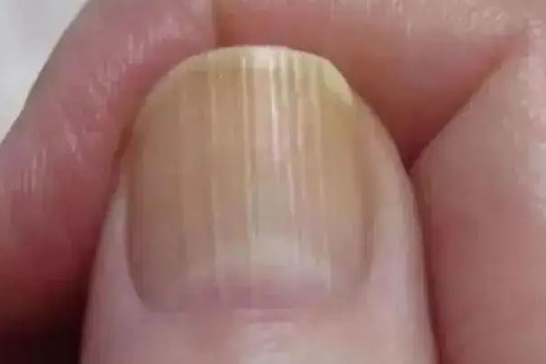 指甲有竖纹是身体的什么信号